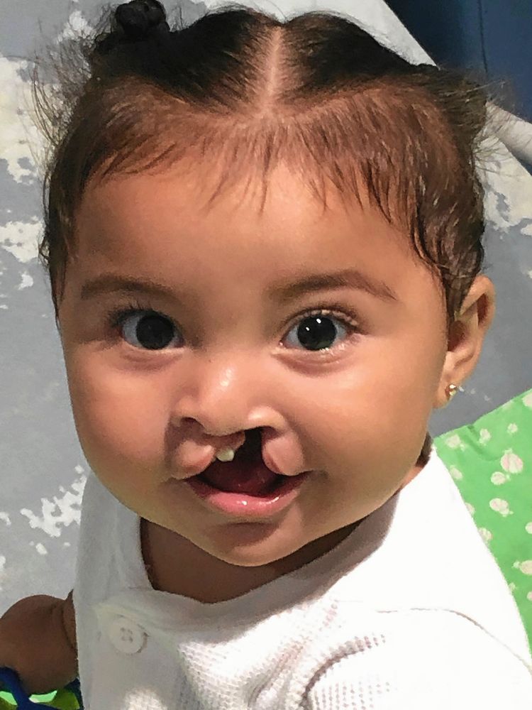 Marianas namne, 1,5 år gamla Mariana från Nicaragua som opererades i mars förra året. Hon hade tur som fick operationen så tidigt i livet. Hon har inte hunnit stängas ute från samhället.