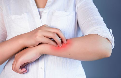 Atopiskt eksem drabbar allt fler i Sverige. Lär dig känna igen symtomen.