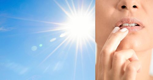 Fula och irriterande munsår på semestern är ingen höjdare. Men det går att lindra plågan.